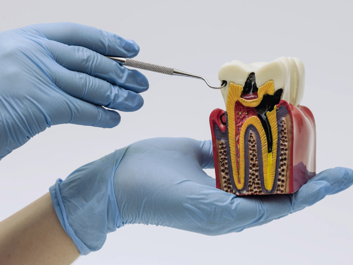 Endodontics, Prosthodontics & Tooth Replacement at Natana Dental